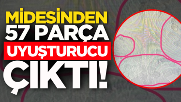 Midesinden 57 parça uyuşturucu çıktı!